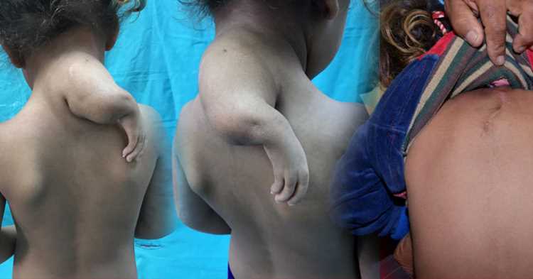 Трехрукой девочке из Аданы подарили нормальную жизнь