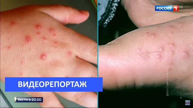 Коксаки в Турции: ложные диагнозы, отмены и обмены туров