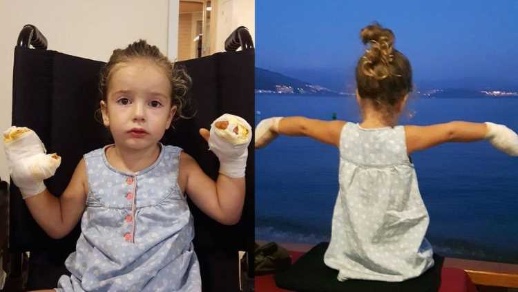 Воздушный шарик обжёг руки 3-летней девочки