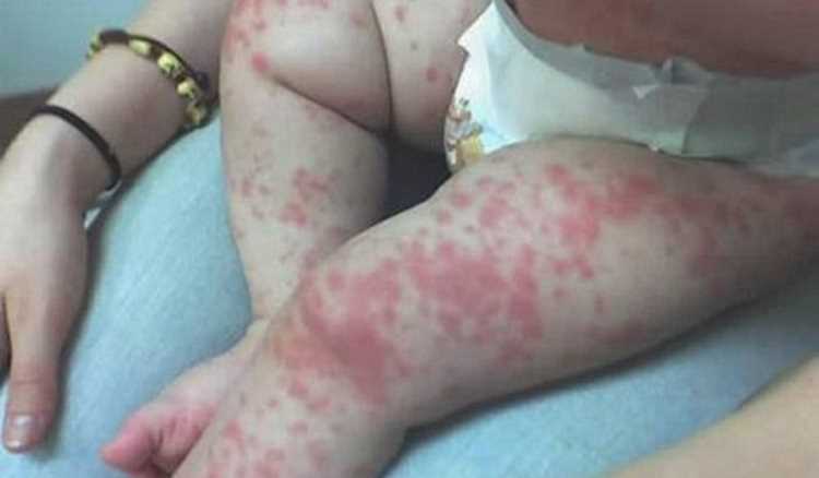 Туристы снова жалуются на Коксаки в Белеке