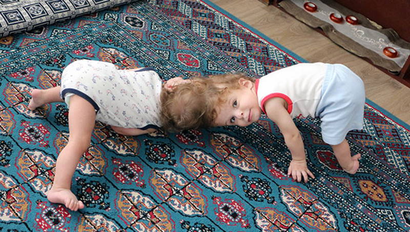 Сиамских близнецов из Антальи успешно разделили