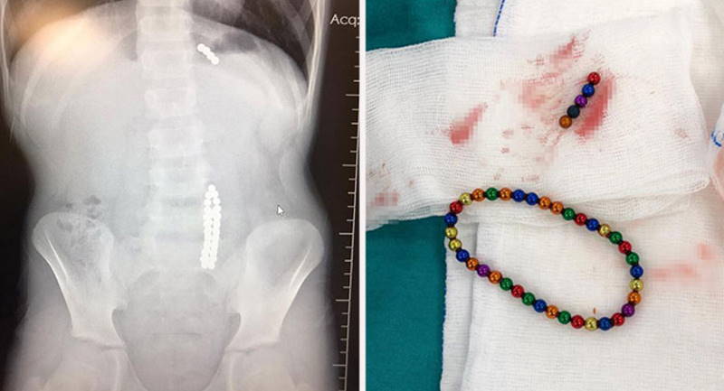 Хирурги достали из ребенка 42 неодимовых шарика